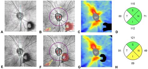 A Representative SD OCT Scan Optic Disc Cube 200 200 For Group W