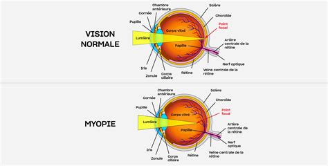 Myopie Diagnostic Et Traitement à Paris Au Centre Ophtalmologique Coss