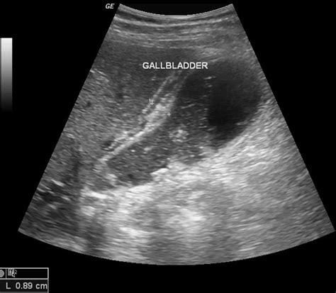 Acute Cholecystitis Core Em