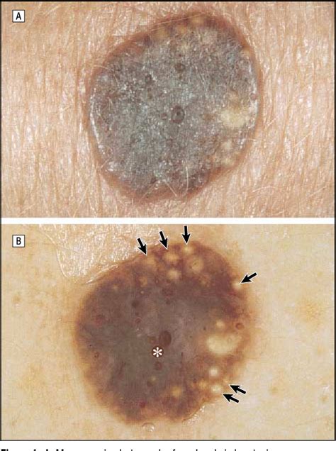 Pdf Dermoscopy Of Pigmented Seborrheic Keratosis A Morphological