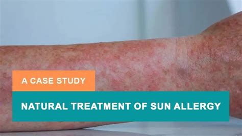 Natural Treatment Of Sun Allergy A Case Study