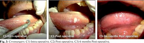 Figure 3 From A Comparative Evaluation Oral Leukoplakia Surgical