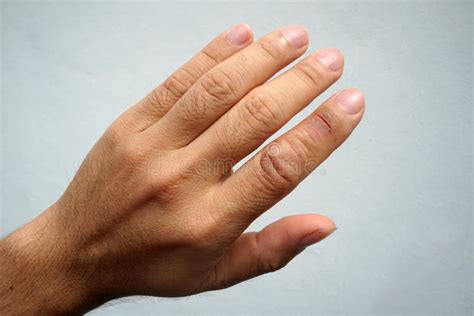 Skin Is Matt And Cracked The Index Finger Is Wound Finger Dermatitis