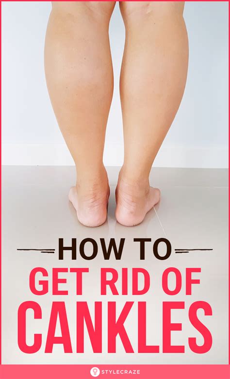 Awasome How To Get Rid Of Cankles Surgery Ideas
