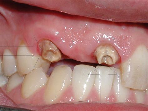 Badly Decayed Abcessed Teeth Pictures Tooth6 Tooth8 Dr Caputo