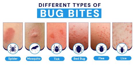A Complete Guide To Insect Bites And Stings Symptoms Treatment