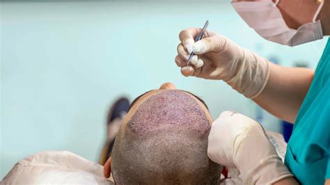 Details More Than Hair Transplant Images Best In Eteachers