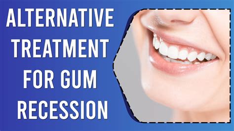 Gum Recession Alternative Treatment For Gum Recession Youtube