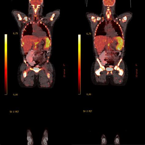 18f Fdg Petct In One Patient With Multiple Myeloma 18f Fdg Petct Scan