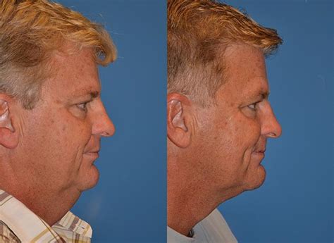 Patient 122406454 Laser Assisted Weekend Neck Lift Before And After
