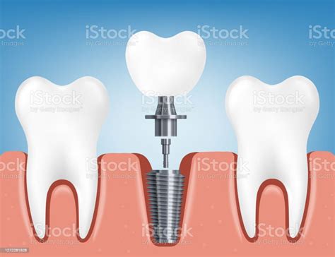 Ilustración De Instalación De Un Implante Dental Una Ilustración