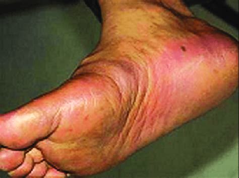 Erythema And Swelling Over Heels And Soles 4 Days Following The First
