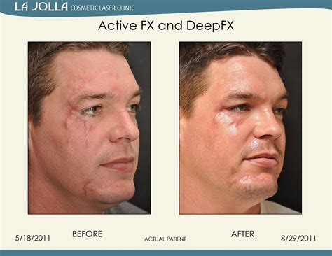Patient Treated With Activefx And Deep Fx At La Jolla Cosmetic Laser