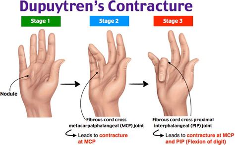 Icd 10 Code For Dupuytrens Contracture Hand