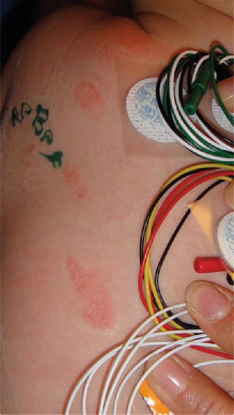 Allergic Contact Dermatitis Caused By Self Adhesive Electrocardiography