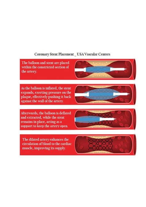 What Is An Angioplasty Procedure Usa Vascular Centers
