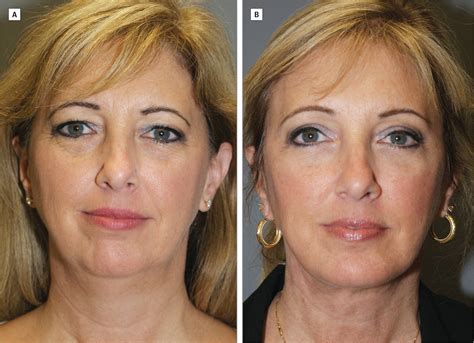 effect of facial rejuvenation surgery on perceived attractiveness femininity and personality