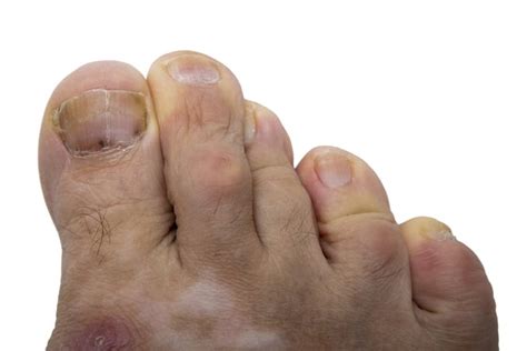 Dont Be Misdiagnosed Know The Signs Of Toenail Melanoma