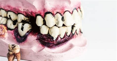 What Does A Cavity Look Like