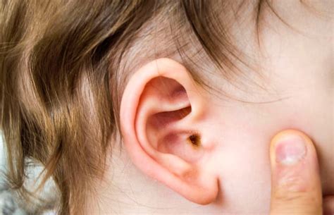 Ear Infections In Children Natures Intentions Naturopathic Clinic