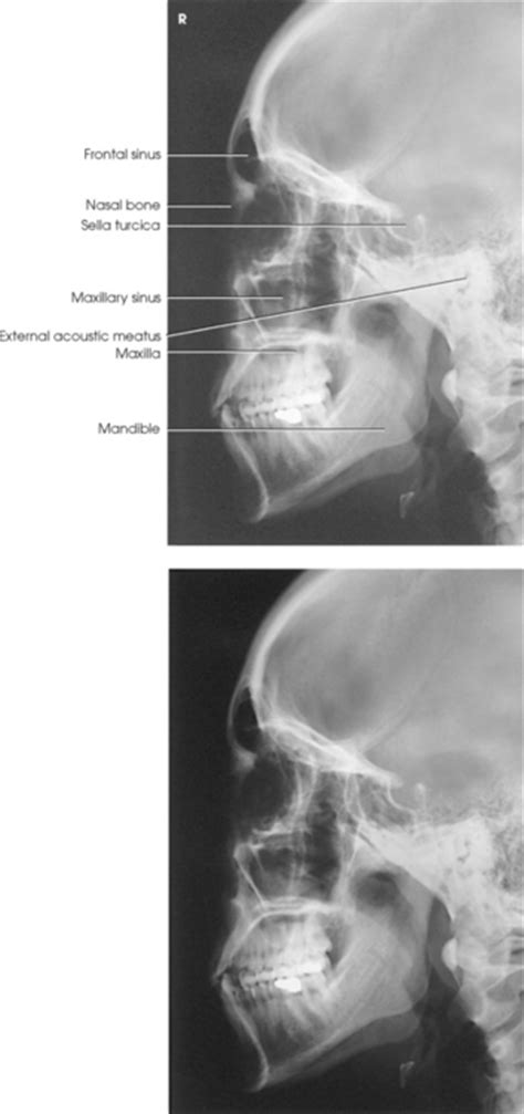 Lessen exposure factors for the nadal bones. FACIAL BONES | Radiology Key