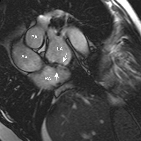 Magnetic Resonance Imaging After Percutaneous Closure Of A Patent