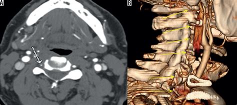 Traumatic Vertebral Artery Injury A Review Of The Screening Criteria Imaging Spectrum Mimics