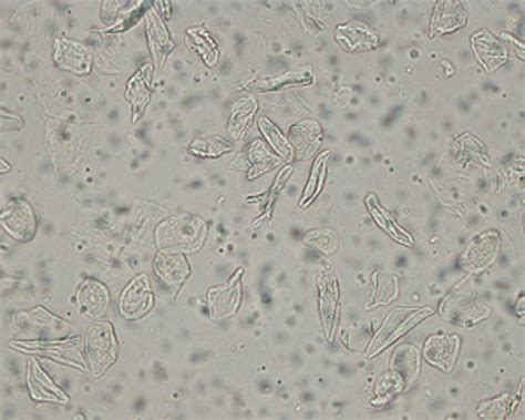 Preted as rbc or wbc, folded cells may be misinterpreted as casts. Transitional Epithelial Cells In Urine - Deep Kitchen Sink