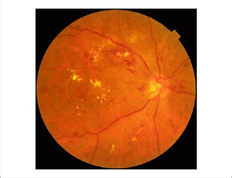 Nonmydriatic Digital Retinal Photography Of A Patient With Severe