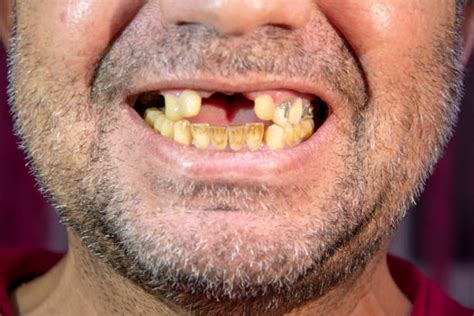 Bad Teeth Stock Photos Pictures And Royalty Free Images Istock