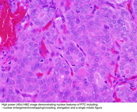 Pathology Outlines Noninvasive Follicular Thyroid Neoplasm With