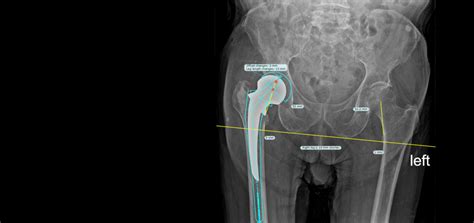 Hip Revision Surgery From Fracture To Success Brainlab