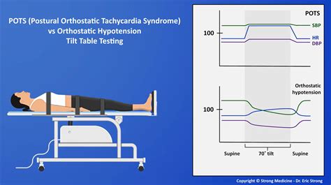 Diagnosis And Management Of Postural Orthostatic Tachycardia Syndrome