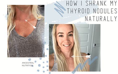 How I Shrank My Thyroid Nodules Naturally Ancestral Nutrition