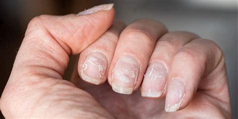 Why Are My Nails Peeling 7 Causes Of Flaking Peeling Nails