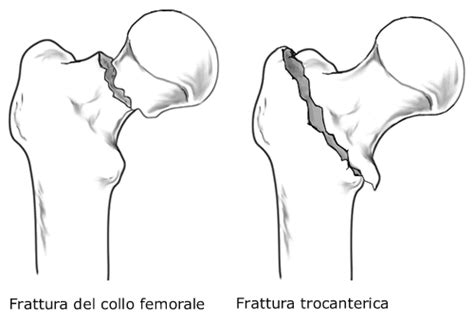 Terzaet@.com - Medicina e salute - Frattura dell'anca nell ...