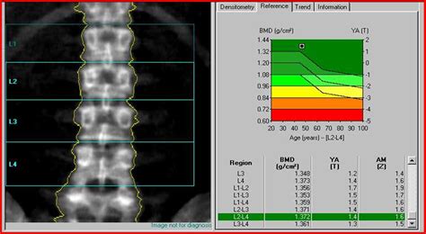 Bone density scan results may also be needed if they will make a difference to how your doctor 'manages' or treats other medical conditions you may have. DEXA - Lexington Diagnostic Center