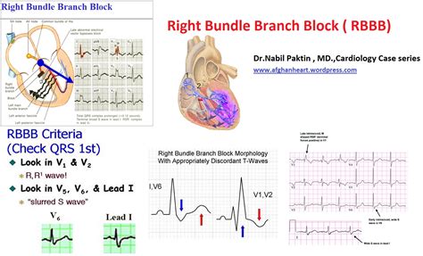 Right Bundle Branch Block RBBB CardioOnline Basic And Advanced