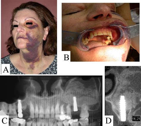 Soft Tissue Swelling