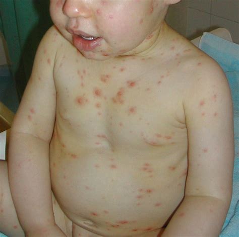 Le macchie rosse sulla pelle dei bambini le cause più comuni