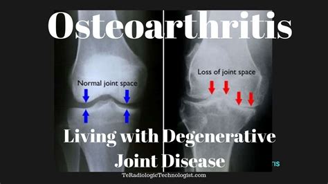 Osteoarthritis Living With Degenerative Joint Disease