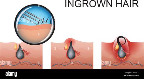 Ingrown Hair Follicle Pictures Ingrown Hair Cyst Symptoms Treatment