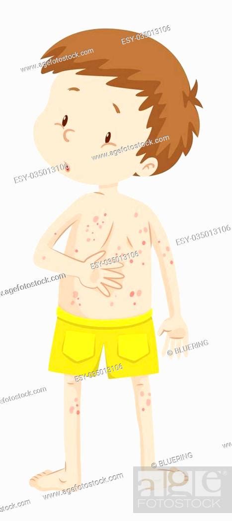 Little Boy With Rashes In His Back Illustration Stock Vector Vector