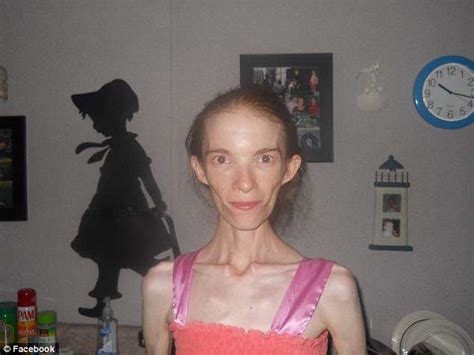 Anorexia Patient Who Weighs 58lbs Prepares For An Early Death Daily