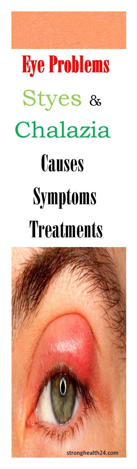 Eye Problems Styes And Chalazia Causes Symptoms Treatments With