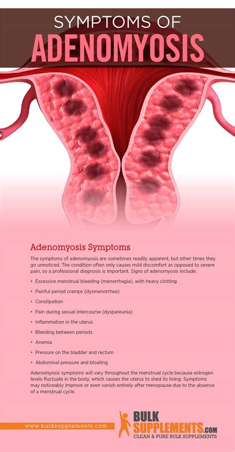 Tablo Read Adenomyosis Causes Symptoms And Treatment By