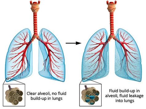 fluid in the lungs major causes and best treatments md