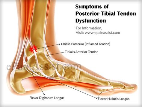 Symptoms Of Tibialis Posterior Syndrome Or Posterior Tibial Tendon