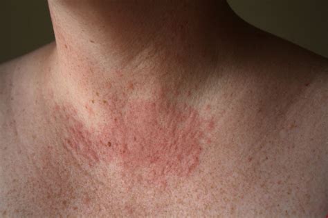 Heat Rash All You Need To Know In 8 Photos