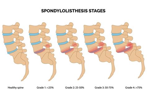 Spondylolisthesis Onz Spine